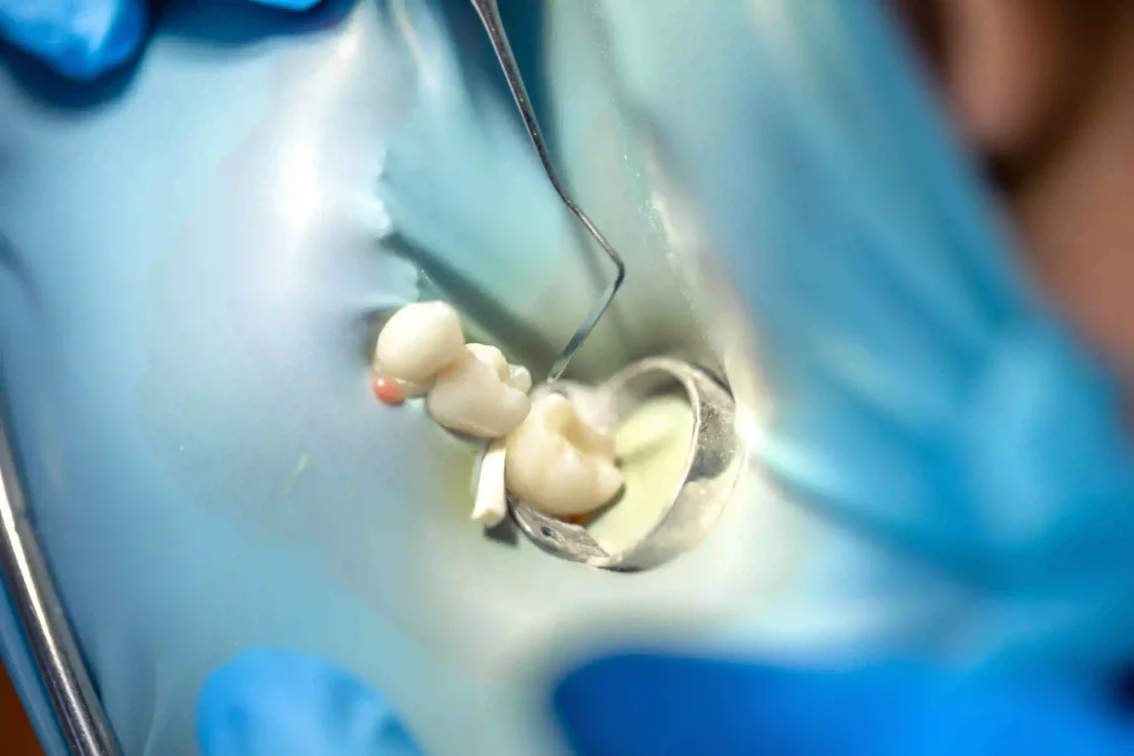 The High Cost of a "Cheap" Extraction 4 Cheap extrations Twinkle Family Dental Care