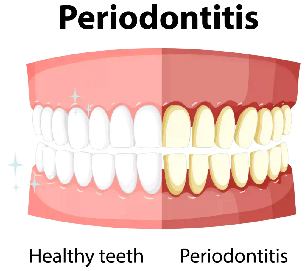 The Silent Epidemic: Why 90% of Kenyans Have Gum Disease (and How to Break the Cycle) 8 Gum diseases Twinkle Family Dental Care