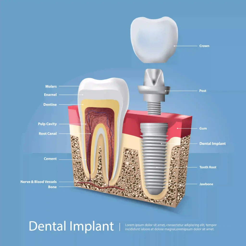 The "Tooth Tourism" Dilemma: Why Getting Dental Implants Locally in Nairobi is the Safer Choice 9 Tooth implant Twinkle Family Dental Care